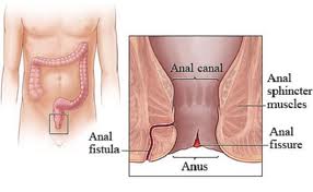 Homeopathic Treatment of Anal Fistula Without Operation in Pakistan image