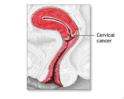 cervical cancer homeo treatment image