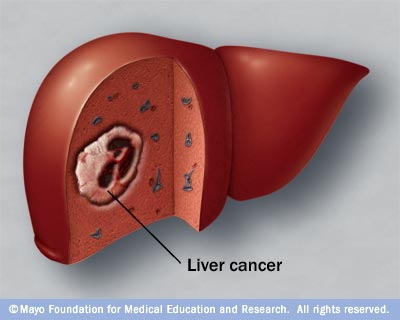 treatment of liver cancer in homeopathy