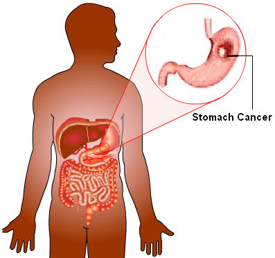 treatment of stomach cancer in homeopathy image