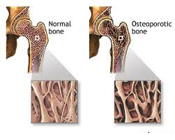 Homeopathic treatment of Osteoporosis in pakistan image