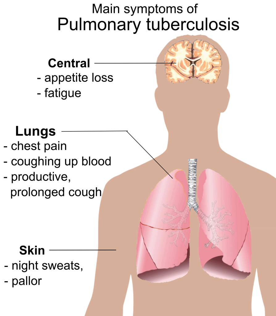 main symptoms of TB image