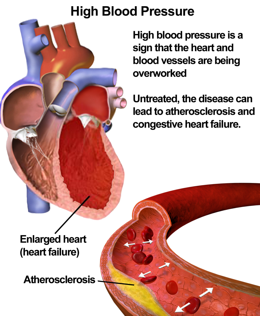 What is hypertension image