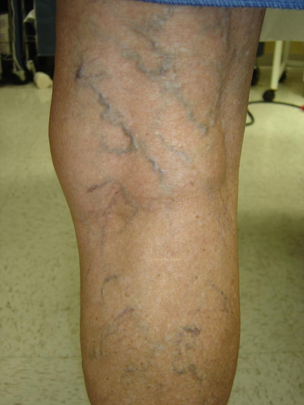 Blue colored varicose veins of foot image