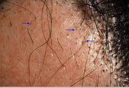 exclamation mark pointed hair in alopecia areat image