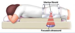 Ultrasound to Diagnose Fibroids image