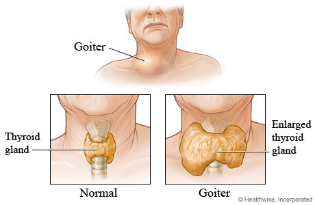 Goiter and enlarged thyroid glands image