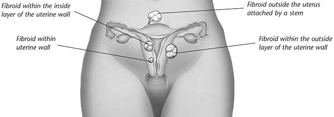 Different locations of uterine fibroids image