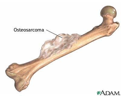 A bone with osteosarcoman