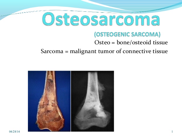 osteosarcoma bones cancer image