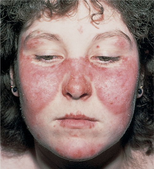 Signs and symptoms of Butterfly Rash or Lupus