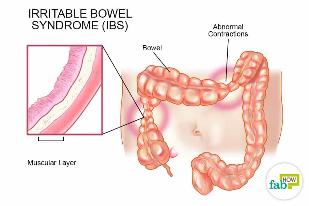 IBS Irritable Bowel Syndrome homeopathic causes and symptoms