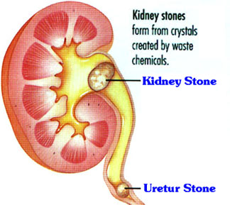 Homeopathic treatment of kidney stones image
