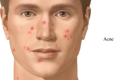 What is Acne image