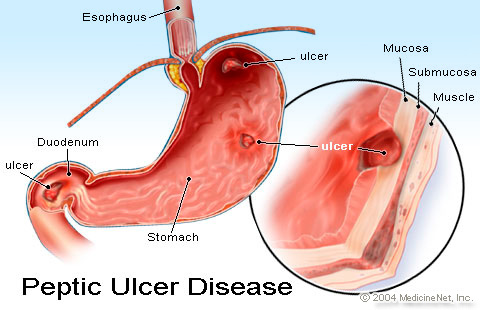 What is peptic ulcer and how is treated in homeopathy image