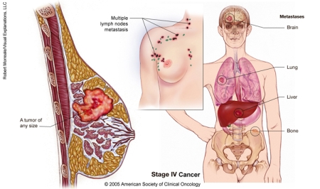homeo treatment of breast cancer