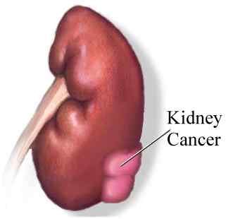 homeopathic treatment of kidney cancer image