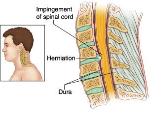 Cervical Disc Disease image