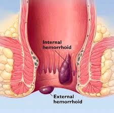 Piles or haemorrhoids homeopathic treatment image