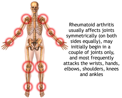Rheumatoid Arthritis patient cured by Dr sabeel