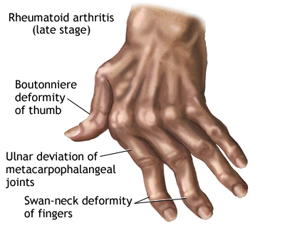 more symptoms of Rheumatoid arthritis image