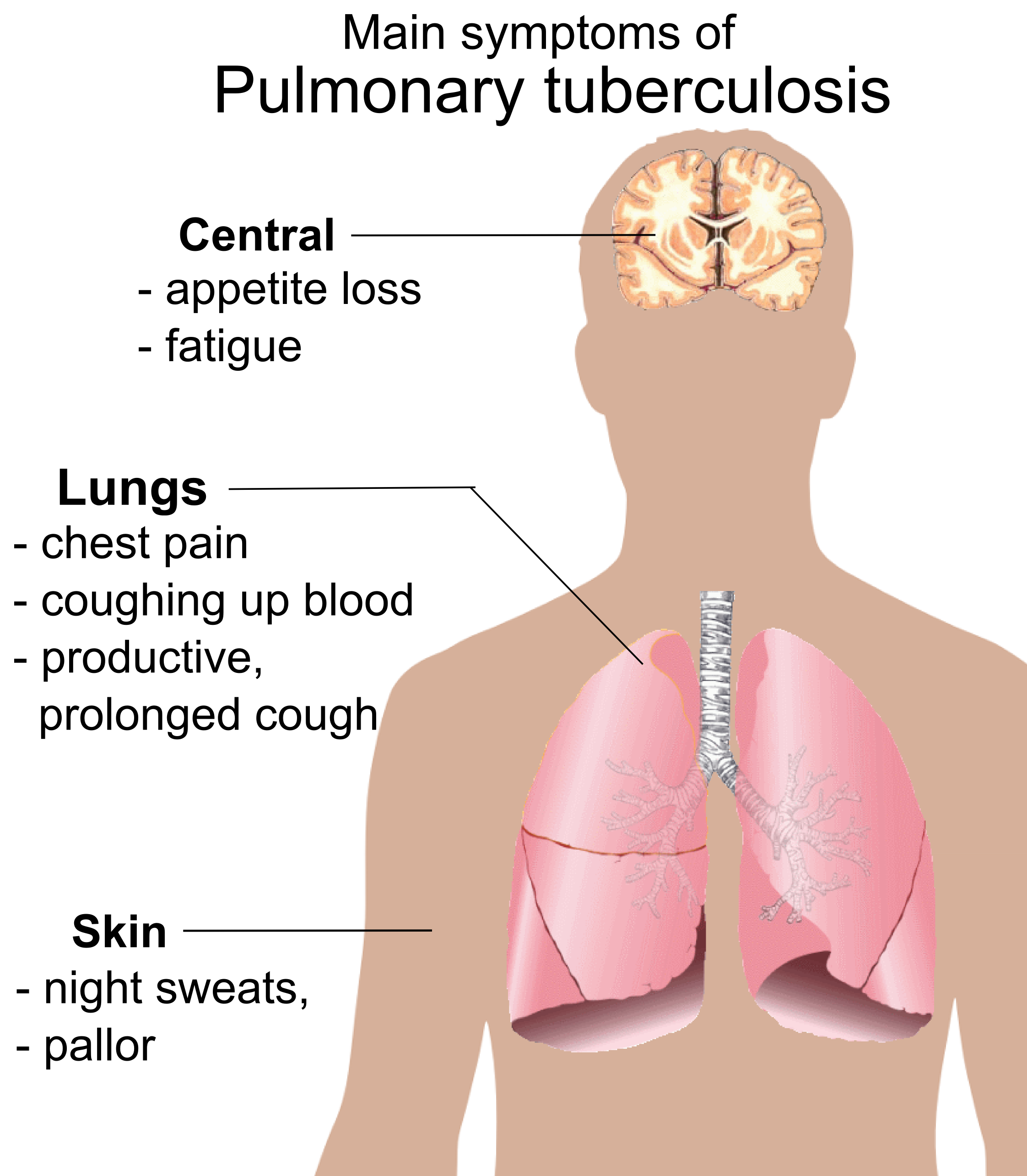 main symptoms of TB image