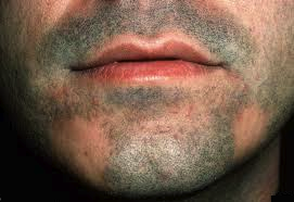 Alopecia-areata effecting beard area