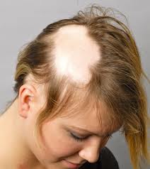 Alopecia-areata also effect women image