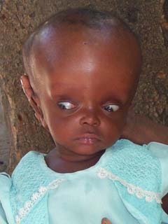 downward eyes in hydrocephalus babies image