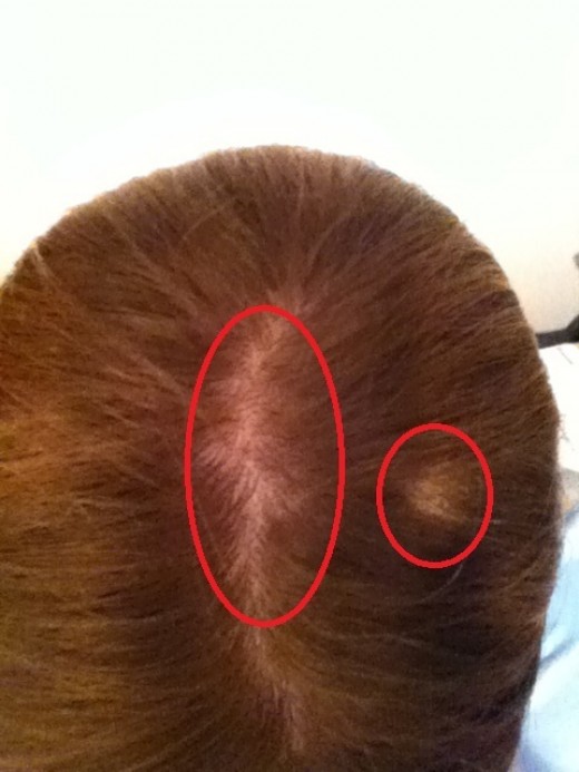 Bald spots on head image