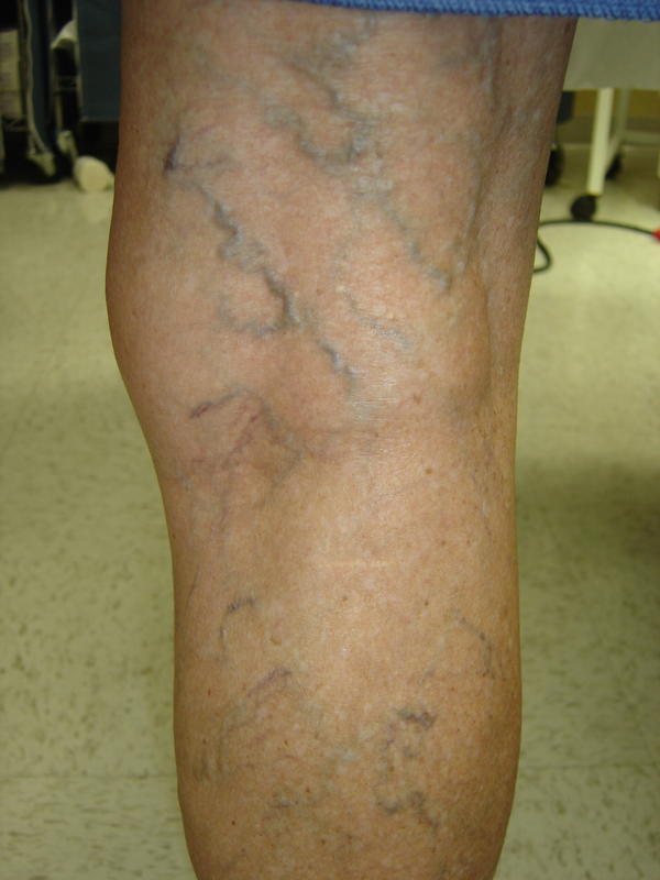 varicose-veins-definition-causes-and-homeopathic-cure-in-pakistan