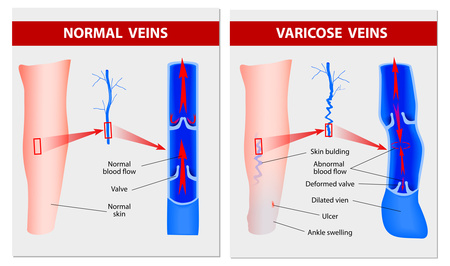 causes of varicose veins image