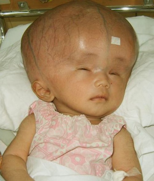A hydrocephalus baby image