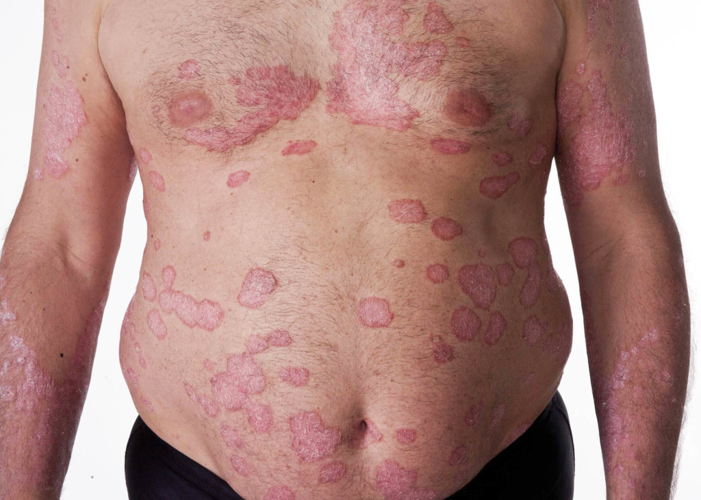 what is Psoriasis image