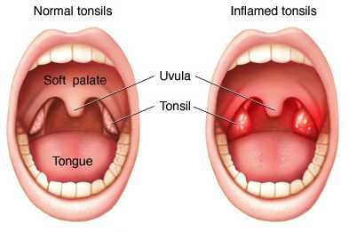 Normal and Inflammed Tonsils image