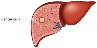 A Liver With Cancer Cells image