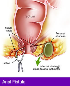 Treatment of Anal Fistula in Pakistan image