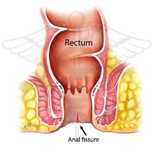 What is anal Fissure?