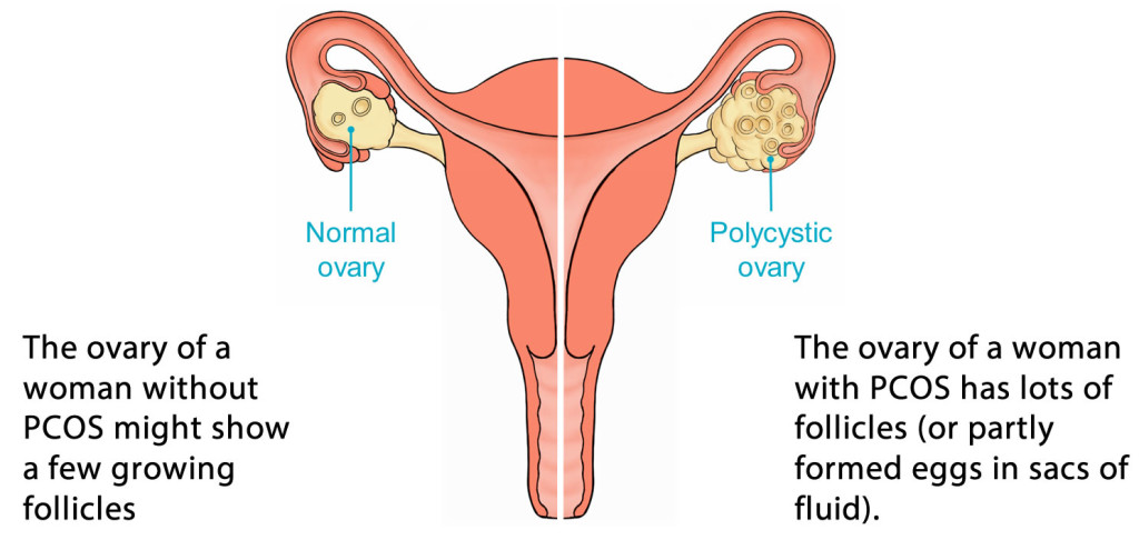 Normal and PCOS Ovary in Women's Reproductive System Image