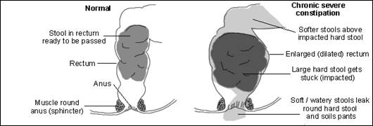 Difference Between Normal and Constipation Condition Image