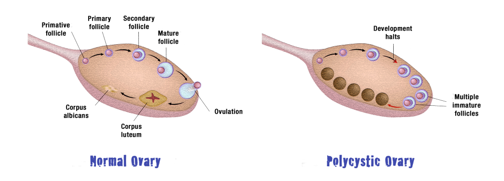Difference Between Normal and Polycystic Ovary Image