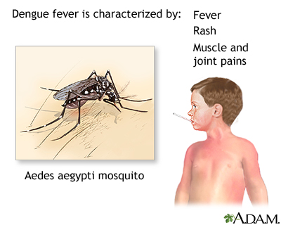 signs of dengue fever