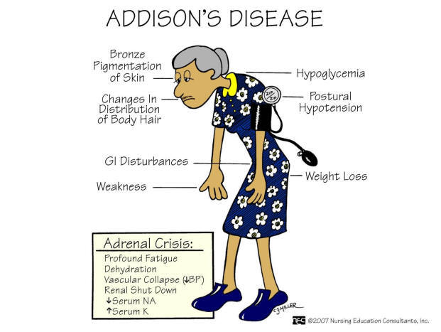 What is Addison Disease?