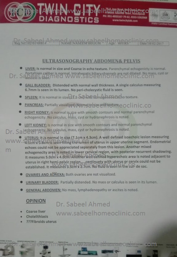 gall bladder stone fibroids