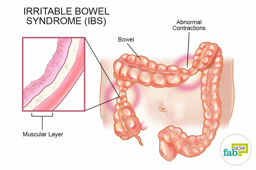 IBS Safe, Natural & Effective Homeopathic Treatment in Pakistan 