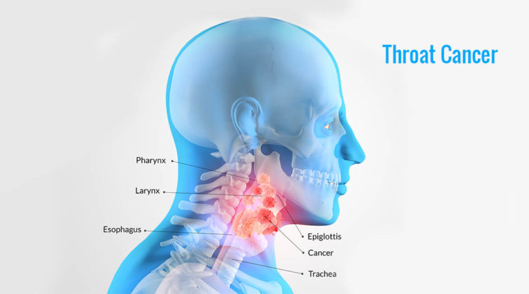 Throat Cancer Causes Symptoms And Effective Homeopathic Treatment 