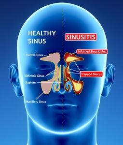 homeopathic doctor sabeel treatment of Sinusitis