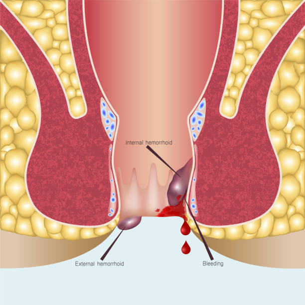 sabeel hoemopathic clinic hemorrhoids treatment