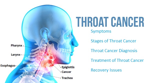 Throat Cancer Causes Symptoms And Effective Homeopathic Treatment   Throat Cancer Causes Symptoms And Homeopathic Treatment 