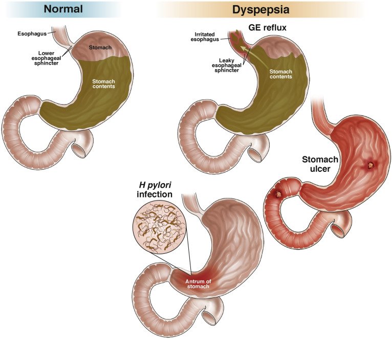 Functional Dyspepsia Treatment Nhs